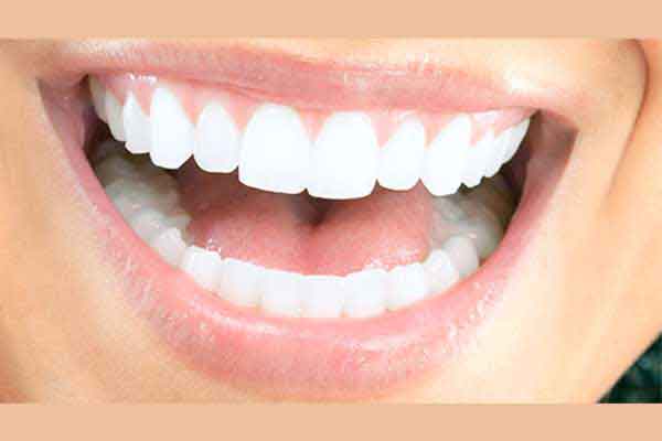 ما هو التصفيح؟ – أنواع شرائح الأسنان