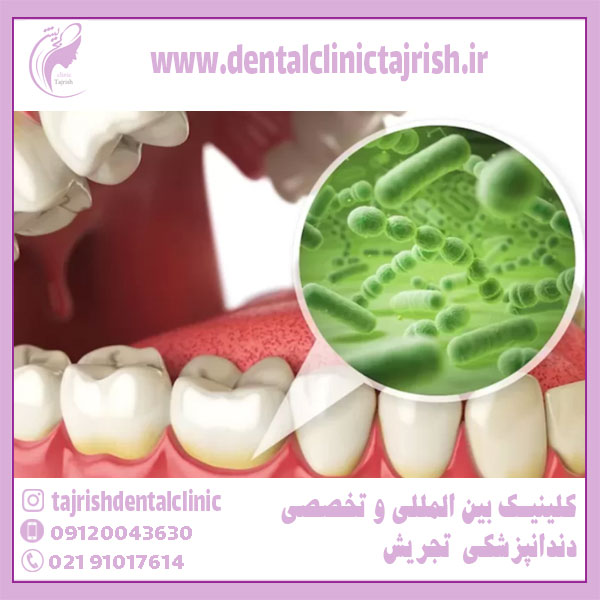 درمان عفونت دندان یا مترونیدازول و اموکسی سیلین
