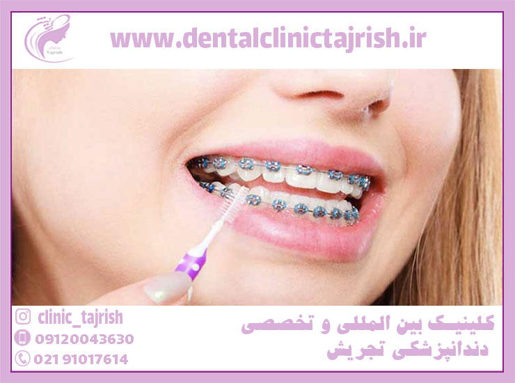 ارتودنسی نزد بهترین دندانپزشک تهران