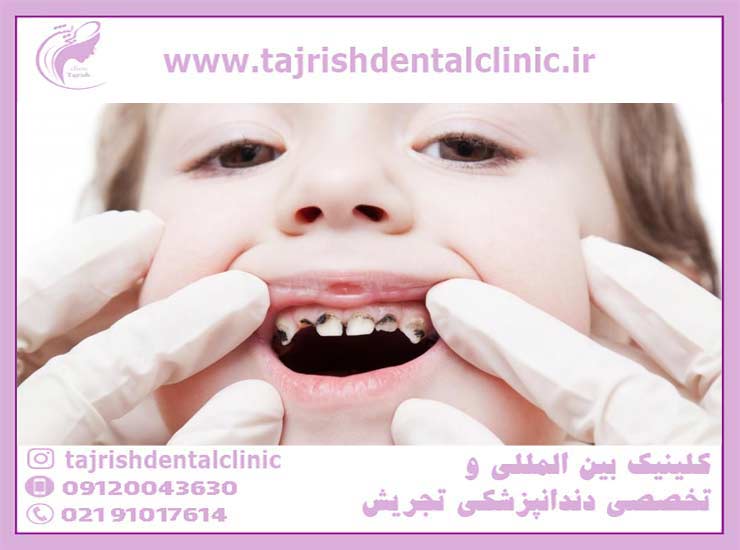  عکس پالپوتومی دندان شیری کودکان