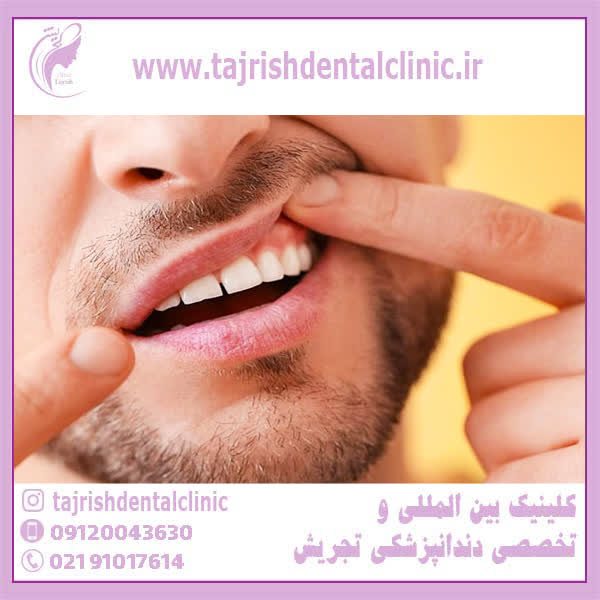 عوارض فیسینگ دندان